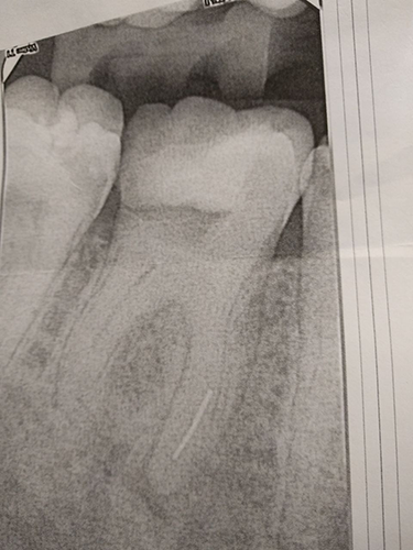 В Одинцово стоматолог забыл сверло в зубе у пациента